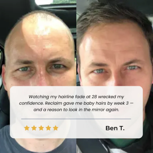 Hair Growth Roll-On Serum — Combat Thinning & Promote Thicker, Fuller Hair(Discount)